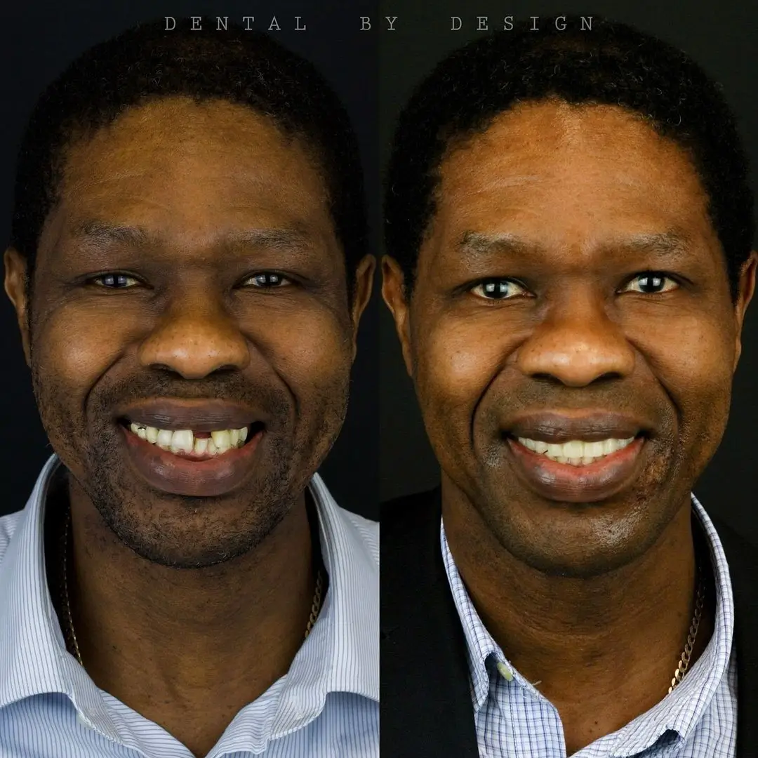 Before/After Image