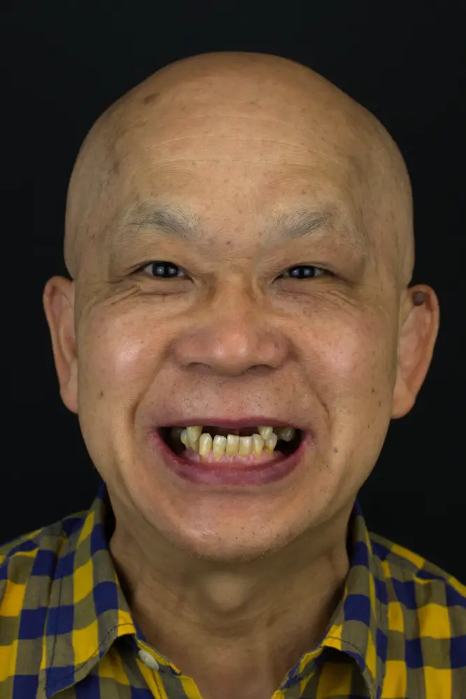 Wang, 70 - Before