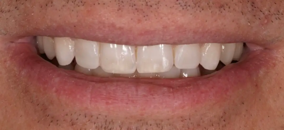 After treatment