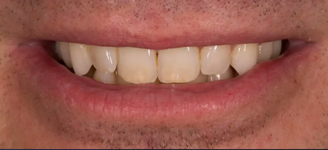 Before treatment