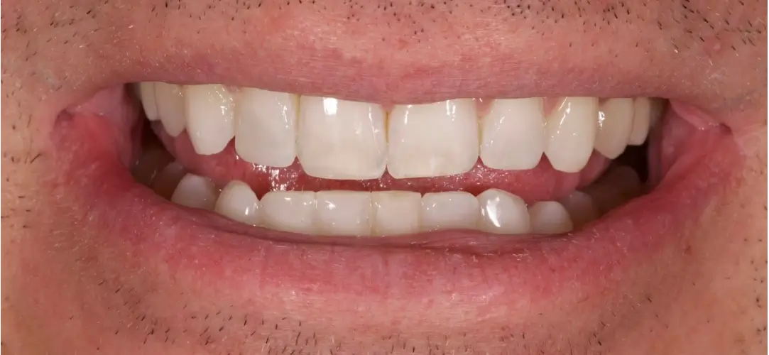 After treatment