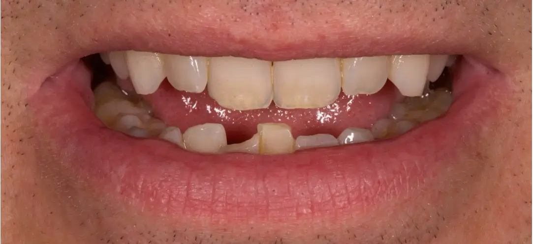 Before treatment