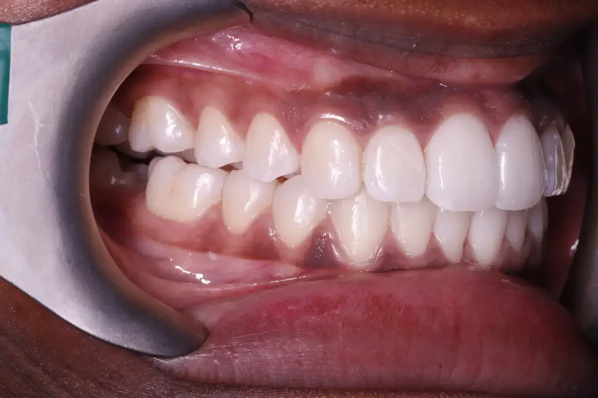 After treatment