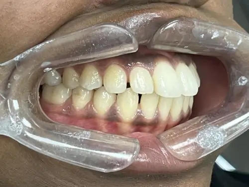Before treatment