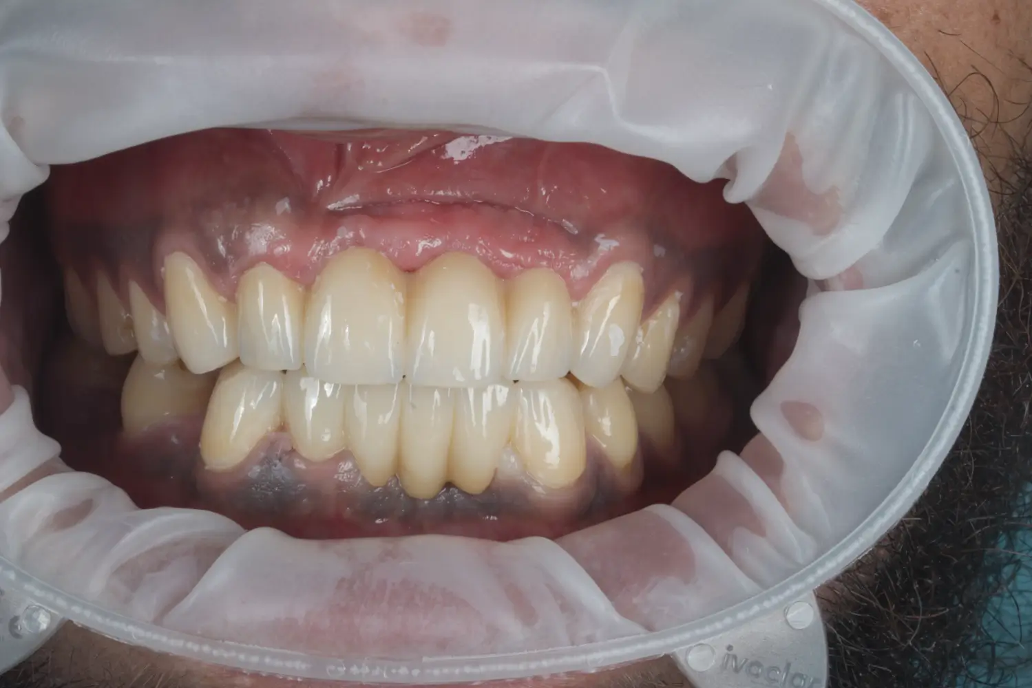 Dexter - After
